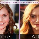 Alyson Stoner Before After Nose Job