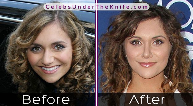 Alyson Stoner Cosmetic Procedure Photos