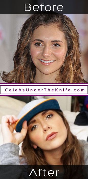 Alyson Stoner Plastic Surgery Results