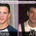 Ben Savage Nose Job Photos