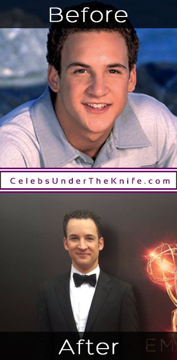 Ben Savage Plastic Surgery Rumors