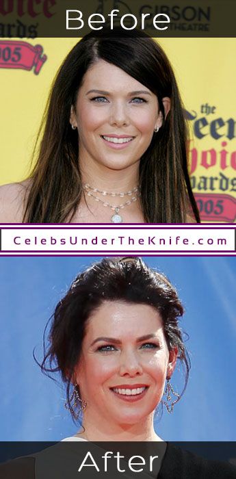 Lauren Graham Before After Surgery Photos