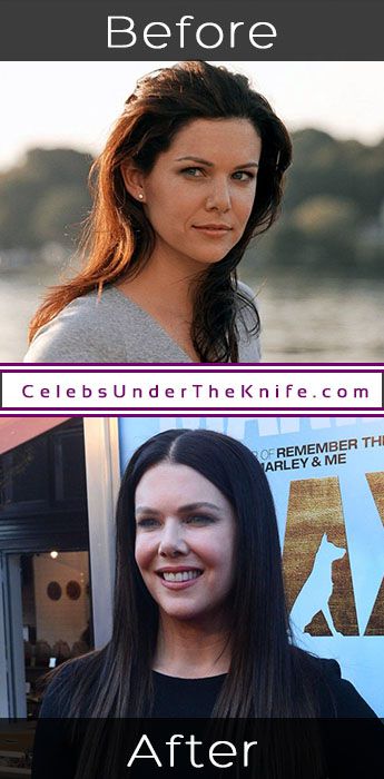 Lauren Graham Plastic Surgery