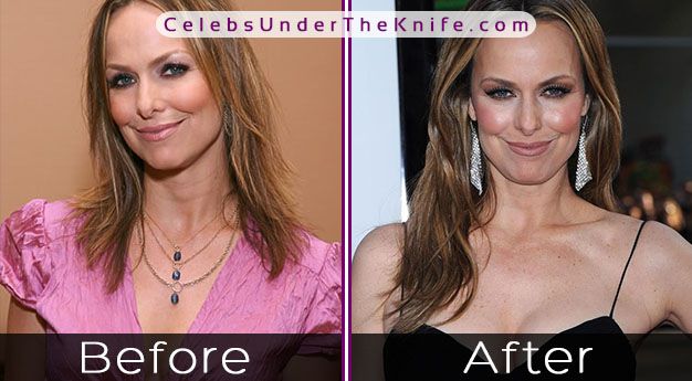 Melora Hardin Cosmetic Procedure Results