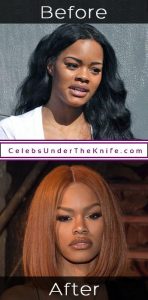 Teyana Taylor Cosmetic Procedure Before and After
