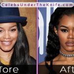 Teyana Taylor Nose Job Photos