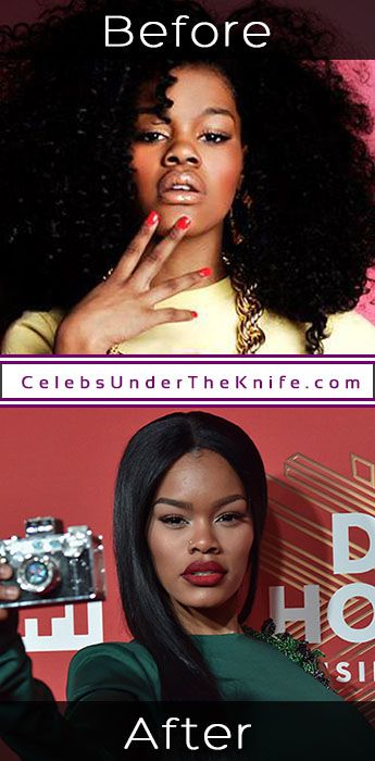 Teyana Taylor Plastic Surgery Pics