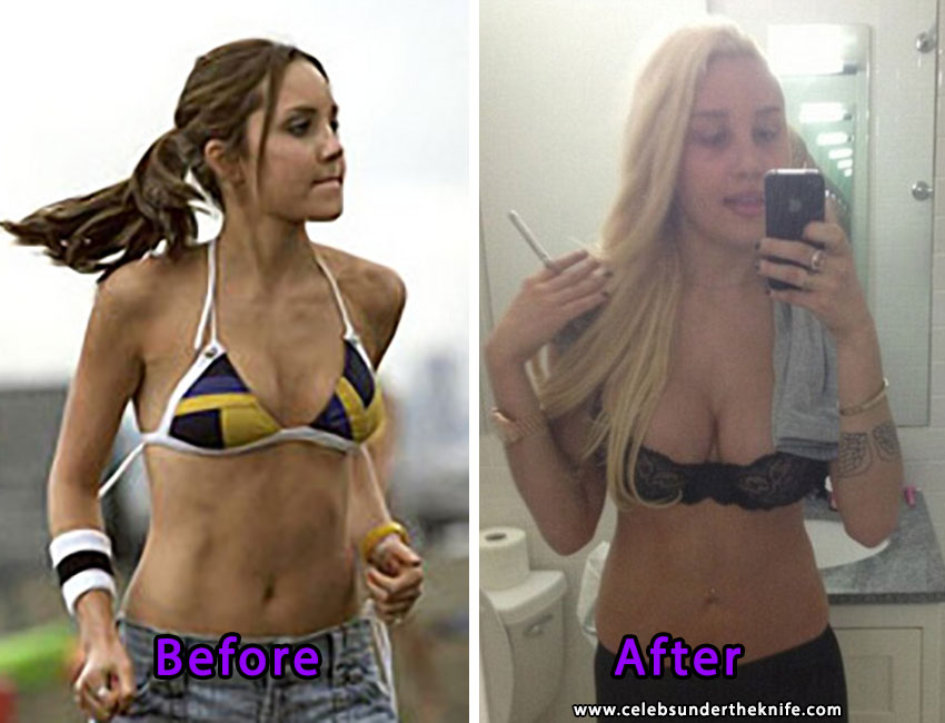 Amanda Bynes before and after breast implants. 