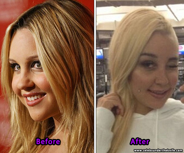 Amanda Bynes Nose Job Plastic Surgery Before After