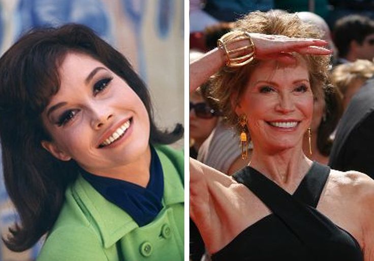 Mary Tyler Moore Plastic Surgery Face